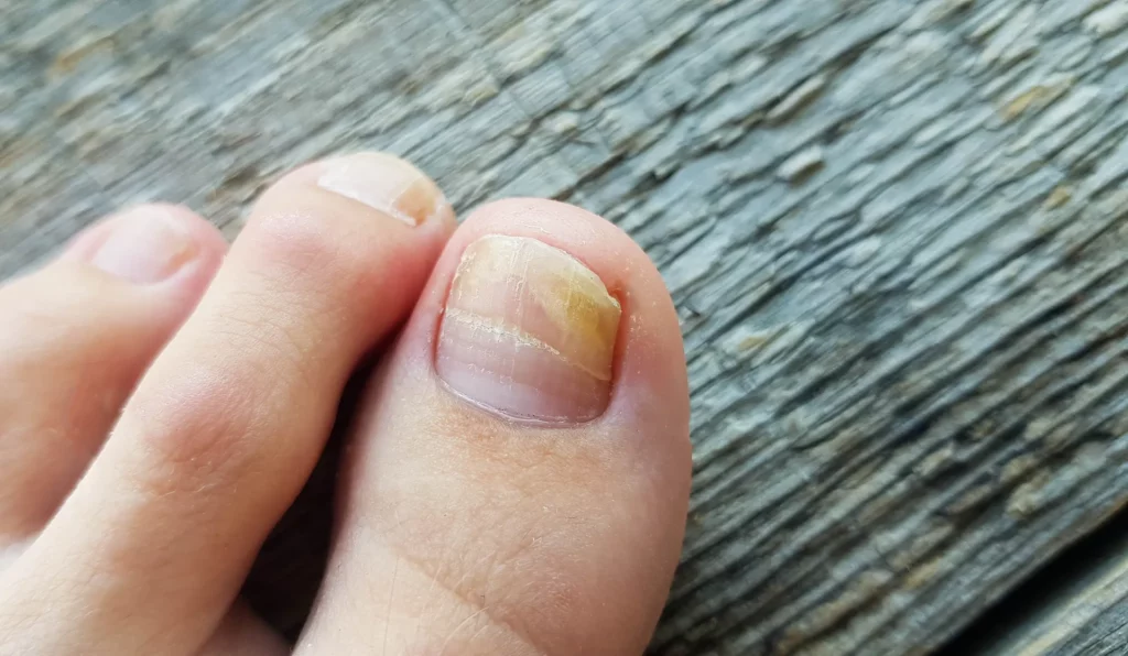 What are the common signs and symptoms of nail issues?